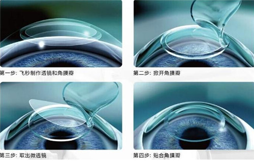 激光手术过程细节图 激光手术过程细节图