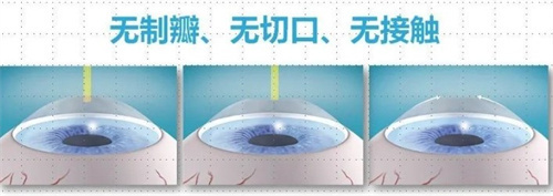 飞秒近视手术 飞秒近视手术