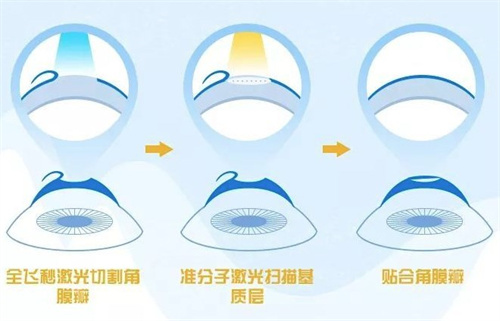 飞秒激光手术过程 飞秒激光手术过程