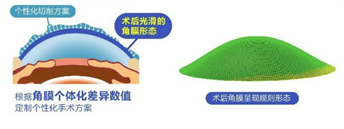 个性化飞秒术后角膜 个性化飞秒术后角膜