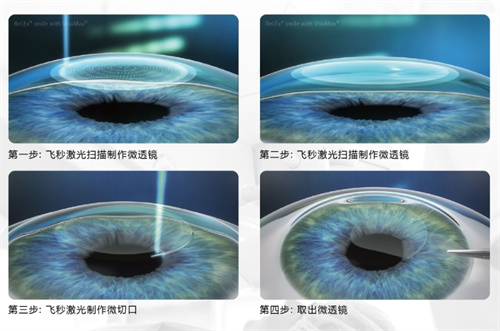 全飞秒手术图 全飞秒手术图