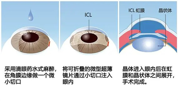icl晶体植入手术方法 icl晶体植入手术方法