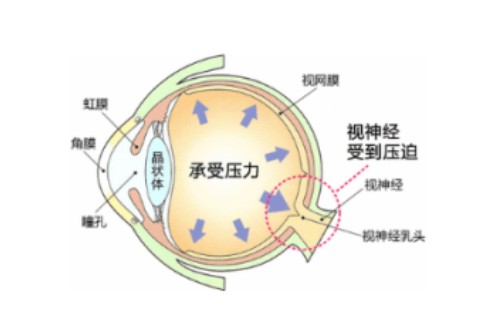 眼睛眼压高概念图 眼睛眼压高概念图