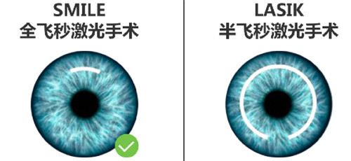 半飞秒和全飞秒手术区别图 半飞秒和全飞秒手术区别图