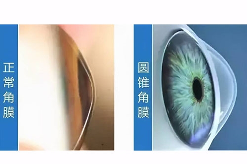 圆锥角膜与正常角膜对比图 圆锥角膜与正常角膜对比图