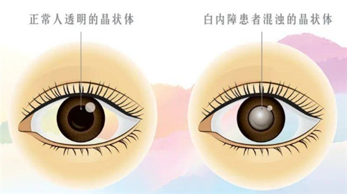 白内障和正常眼球的对比图 白内障和正常眼球的对比图