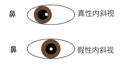 斜视的类型 斜视的类型