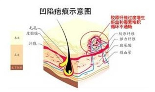 凹陷疤痕 凹陷疤痕