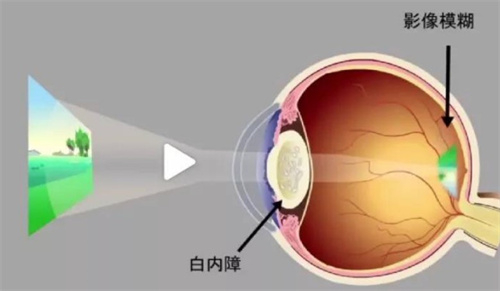 白内障成像 白内障成像