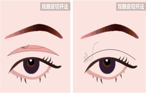 全切双眼皮手术的切口部位 全切双眼皮手术的切口部位