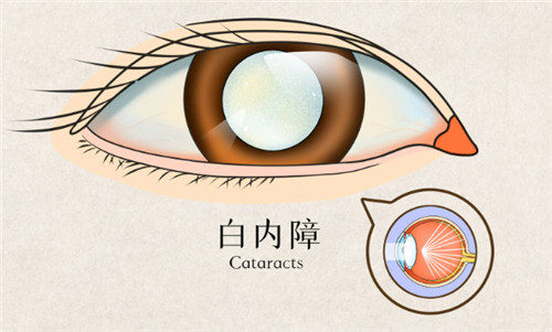 白内障眼睛表现 白内障眼睛表现