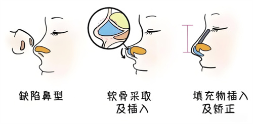 鼻综合手术过程动画 鼻综合手术过程动画