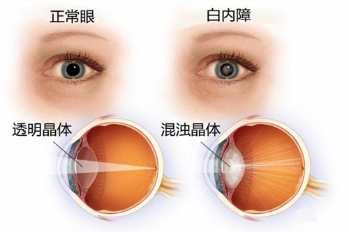 白内障与正常眼睛对比图 白内障与正常眼睛对比图