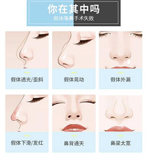 哪些鼻子需要做修复改善 哪些鼻子需要做修复改善