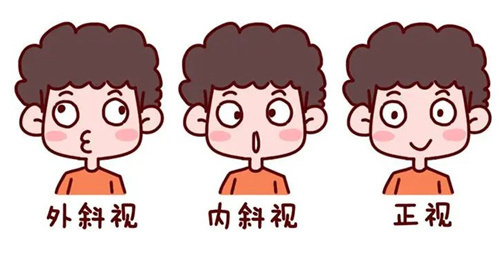 斜视的种类 斜视的种类