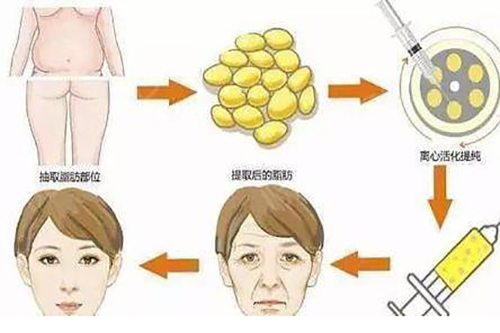 面部脂肪填充过程示意图 面部脂肪填充过程示意图
