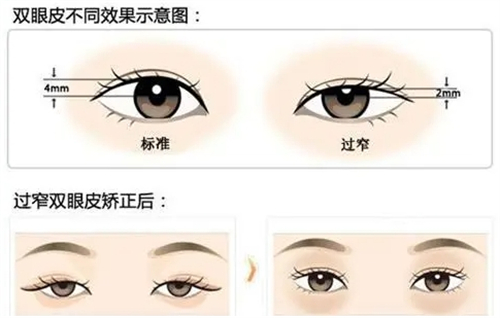 不同高度的双眼皮 不同高度的双眼皮