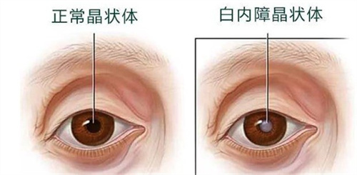 正常晶状体和白内障晶状体 正常晶状体和白内障晶状体