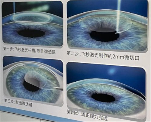 飞秒手术过程图 飞秒手术过程图
