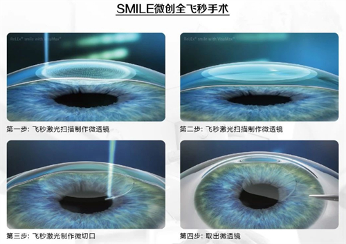 全飞秒手术过程 全飞秒手术过程