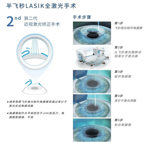 半飞秒手术示意图 半飞秒手术示意图
