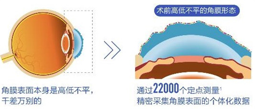 个性化飞秒术前 个性化飞秒术前