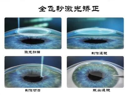 近视眼手术 近视眼手术