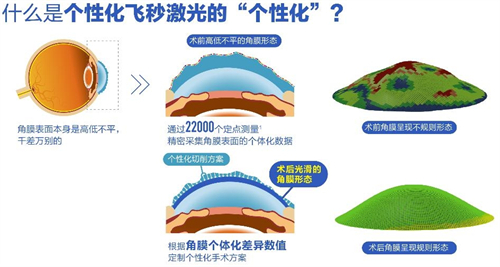 什么是个性化飞秒 什么是个性化飞秒