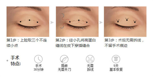 双眼皮三点术过程特点 双眼皮三点术过程特点