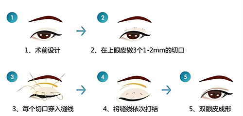 双眼皮三点术过程原理 双眼皮三点术过程原理