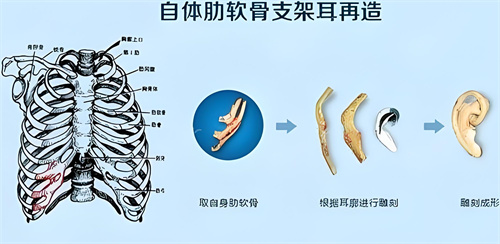 肋软骨直埋耳再造术步骤演示图 肋软骨直埋耳再造术步骤演示图