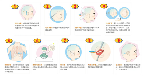 扩张器法耳再造手术动画演示图 扩张器法耳再造手术动画演示图