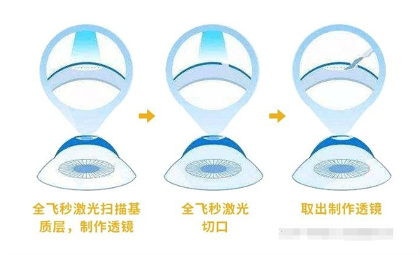 全飞秒激光治眼睛切口 全飞秒激光治眼睛切口