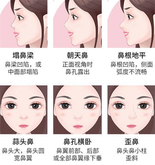 哪些鼻子需要做修复手术 哪些鼻子需要做修复手术