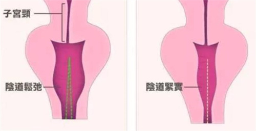 生物束带紧缩术对比 生物束带紧缩术对比