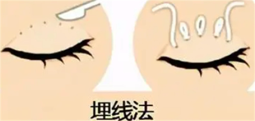 双眼皮埋线怎么做的 双眼皮埋线怎么做的