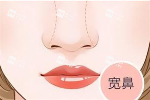 宽鼻形态展示图