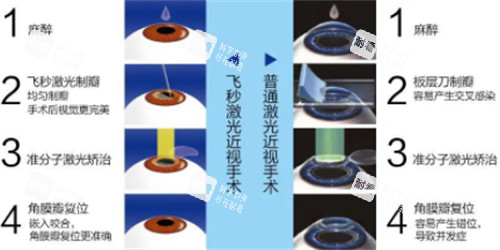 飞秒近视手术与激光近视手术的过程区别图解 飞秒近视手术与激光近视手术的过程区别图解