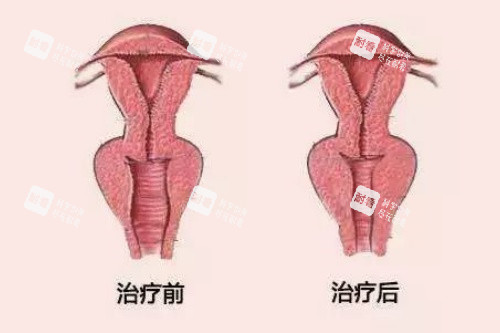阴道紧缩卡通图 阴道紧缩卡通图