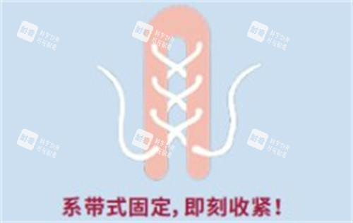 再生阴道紧缩术 再生阴道紧缩术