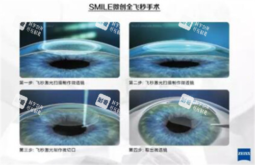 全飞秒手术过程图解 全飞秒手术过程图解
