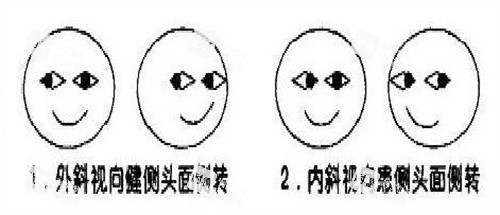 斜视自测图 斜视自测图