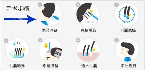 毛发移植手术步骤动画演示图 毛发移植手术步骤动画演示图