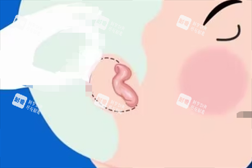 儿童耳再造耳畸形展示 儿童耳再造耳畸形展示