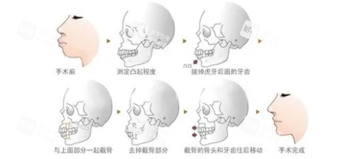 正颌手术步骤图示 正颌手术步骤图示