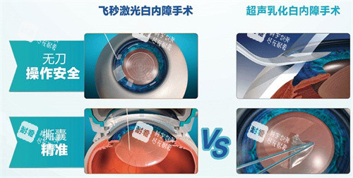 飞秒激光白内障手术和超声乳化白内障手术区别 飞秒激光白内障手术和超声乳化白内障手术区别