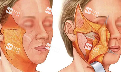 拉皮手术过程动画示意图 拉皮手术过程动画示意图