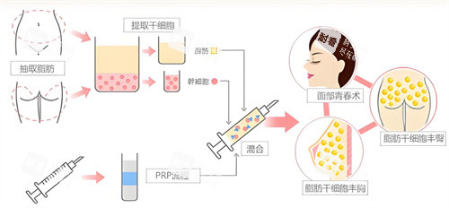 自体脂肪隆胸过程 自体脂肪隆胸过程