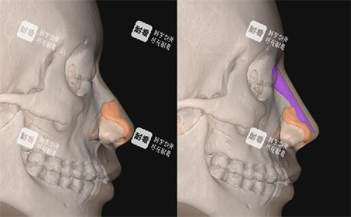 FITme3D鼻假体模拟隆鼻展示