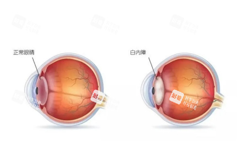 正常眼睛与白内障眼镜对比图